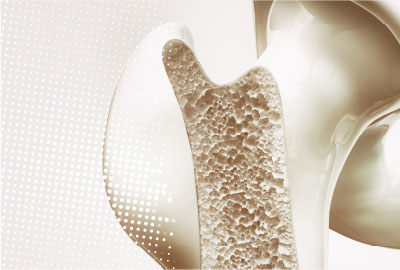 Osteoporosis: diagnóstico y tratamiento